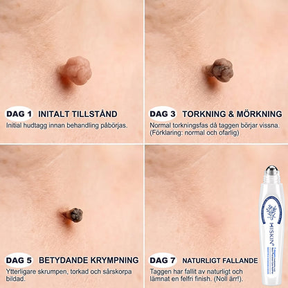 𝐇𝐈𝐒𝐊𝐈𝐍®👩‍⚕️ 𝟕-𝐝𝒂𝙜𝙖𝙧𝙨 𝐛𝐞𝐡𝐚𝐧𝐝𝐥𝐢𝐧𝐠 𝐦𝐨𝐭 𝐡𝐮𝐝𝐟𝐥𝐢𝐤𝐚𝐫 & 𝐡𝐮𝐝𝐟𝐥ä𝐜𝐤𝐚𝐫 – 𝐀𝐯𝐚𝐧𝐜𝐞𝐫𝐚𝐝 𝐫𝐨𝐥𝐥-𝐨𝐧-𝐩𝐞𝐧𝐧𝐚 𝐟ö𝐫 𝐬𝐦ä𝐫𝐭𝐟𝐫𝐢 𝐛𝐨𝐫𝐭𝐭𝐚𝐠𝐧𝐢𝐧𝐠 𝐚𝐯 𝐡𝐮𝐝𝐟ö𝐫ä𝐧𝐝𝐫𝐢𝐧𝐠𝐚𝐫 𝐮𝐭𝐚𝐧 ä𝐫𝐫